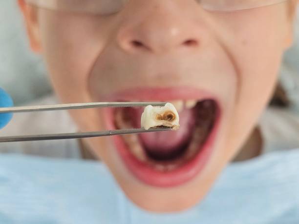 Best Emergency Tooth Extraction in Wagoner, OK
